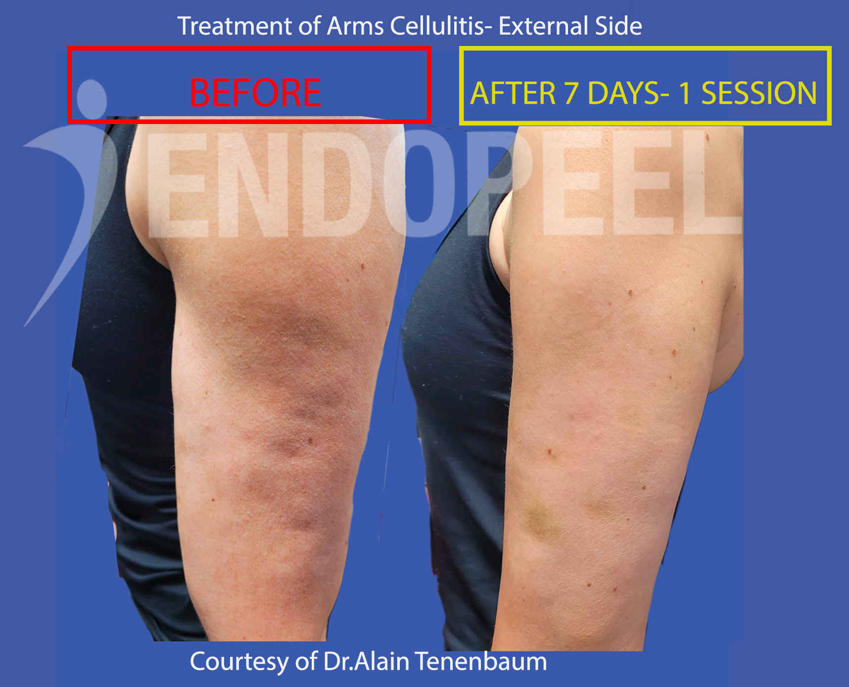 arms-cellulitis-final
