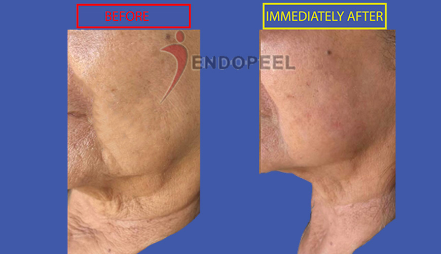 endopeel for aging face