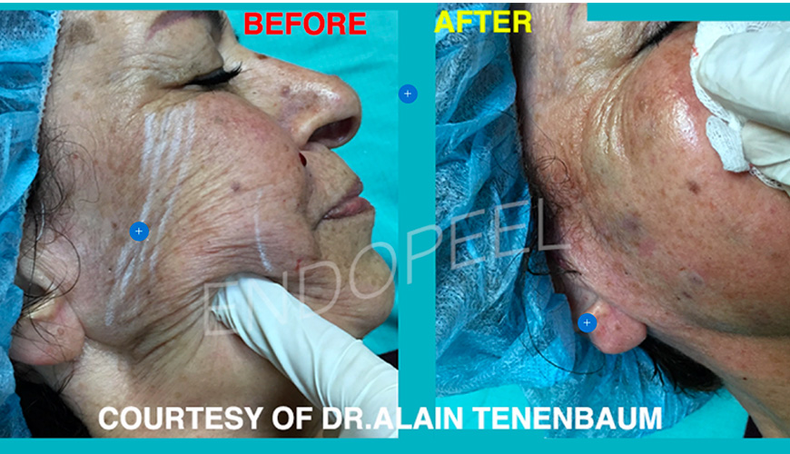 cutaneous hydration treated with Endopeel